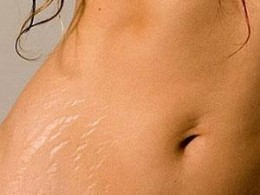 stretch marks